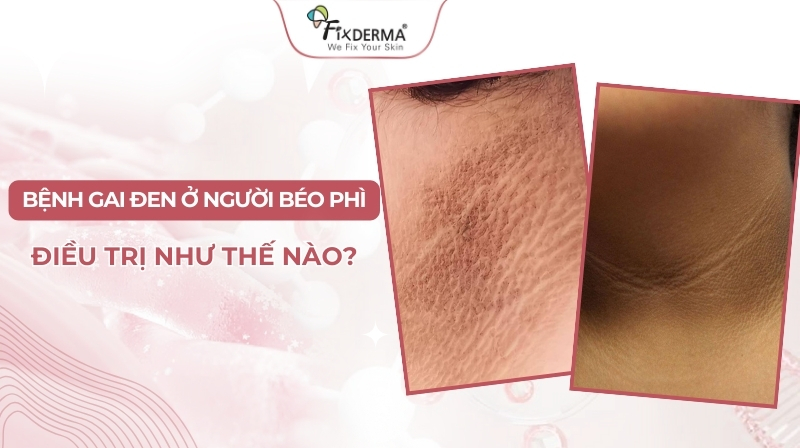 Bệnh gai đen ở người béo phì