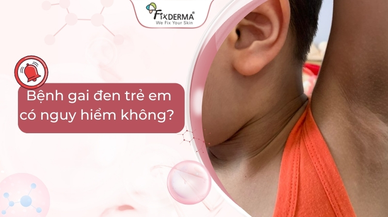 bệnh gai đen trẻ em