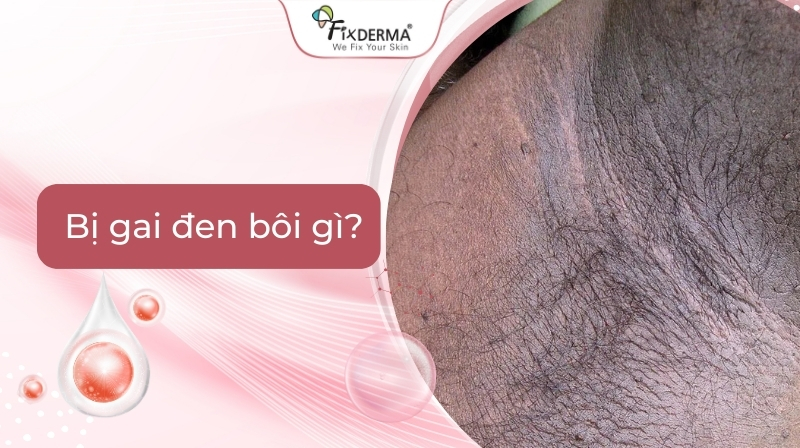 bị gai đen bôi gì