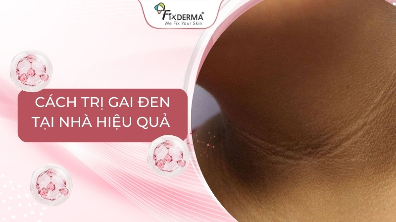 cách trị gai đen tại nhà