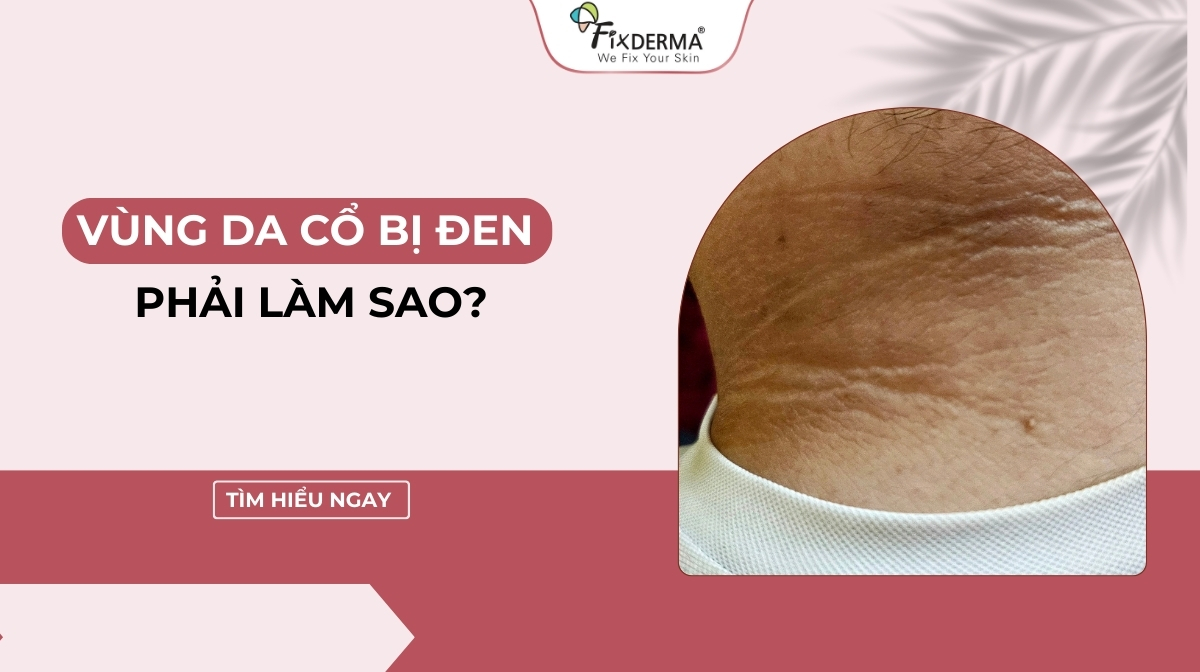 vùng da cổ bị đen