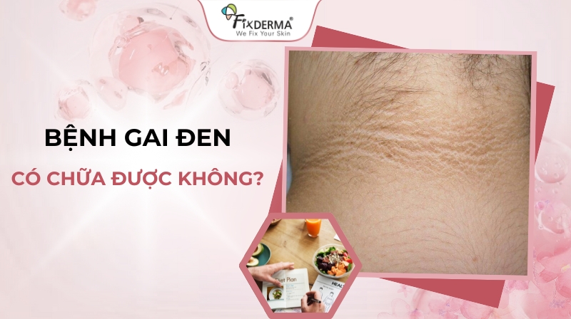 gai đen có chữa được không