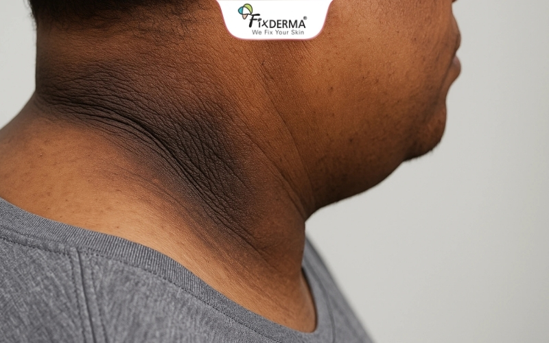 Gai đen có thể là lời cảnh báo sức khỏe của bạn