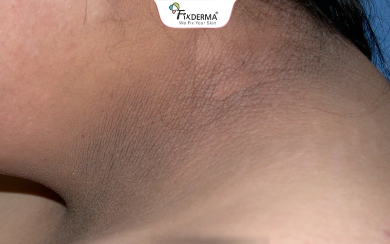 Nhận biết gai đen qua bệnh tiểu đường