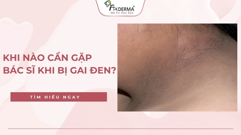 khi nào cần gặp bác sĩ khi bị gai đen