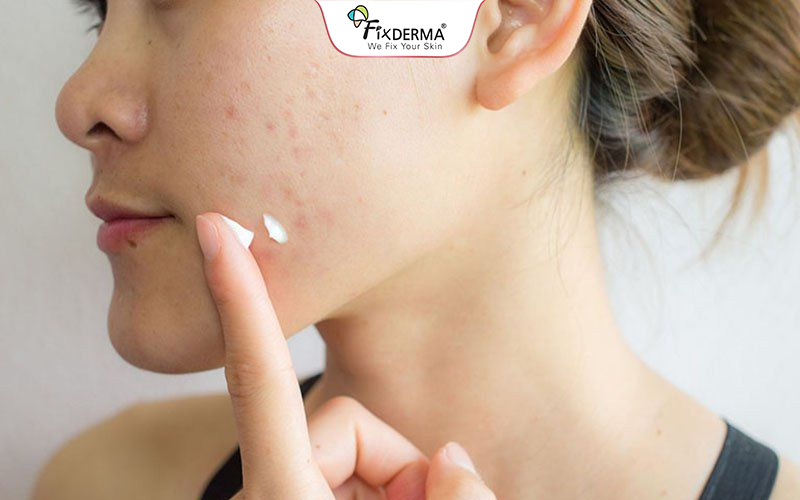 Bôi thoa sản phẩm có chứa các hoạt chất Axit salicylic, Retinoids, AHA,.. giúp giảm thâm đỏ