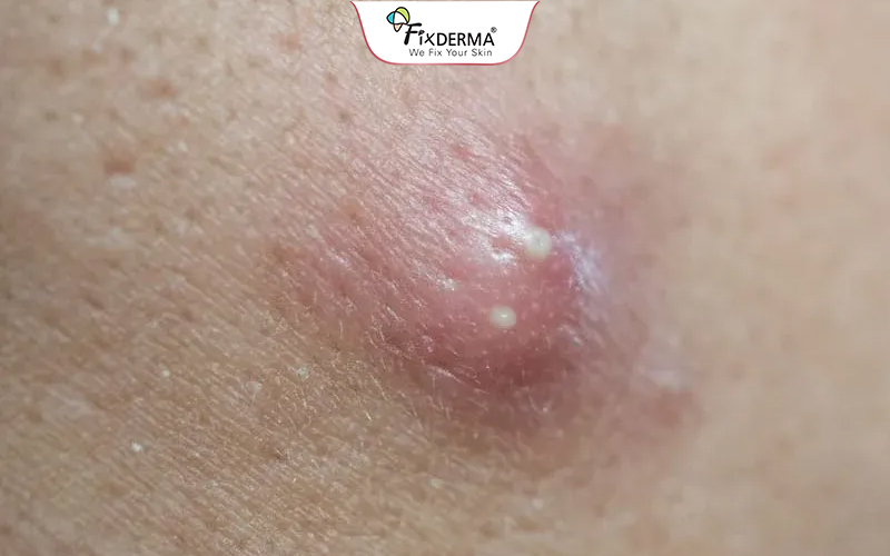 Mụn bọc là dạng mụn viêm nặng