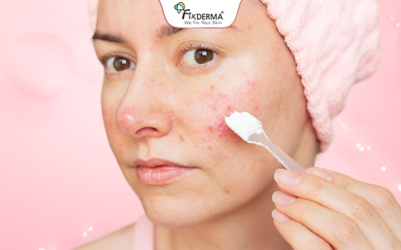 Dùng mỹ phẩm hỗ trợ giảm mụn