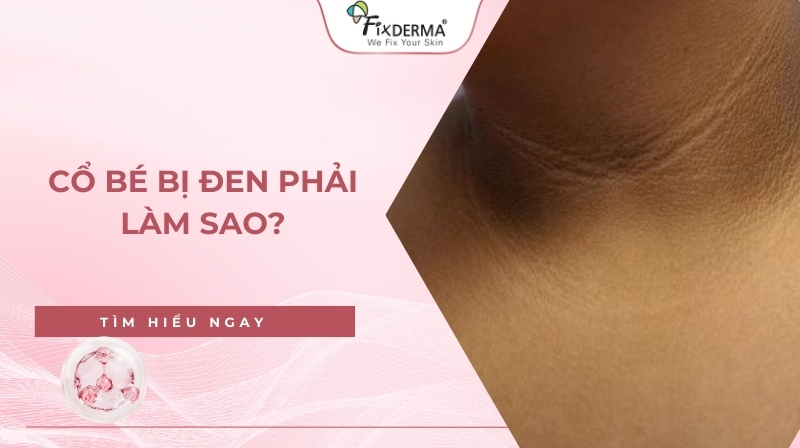 cổ bé bị đen