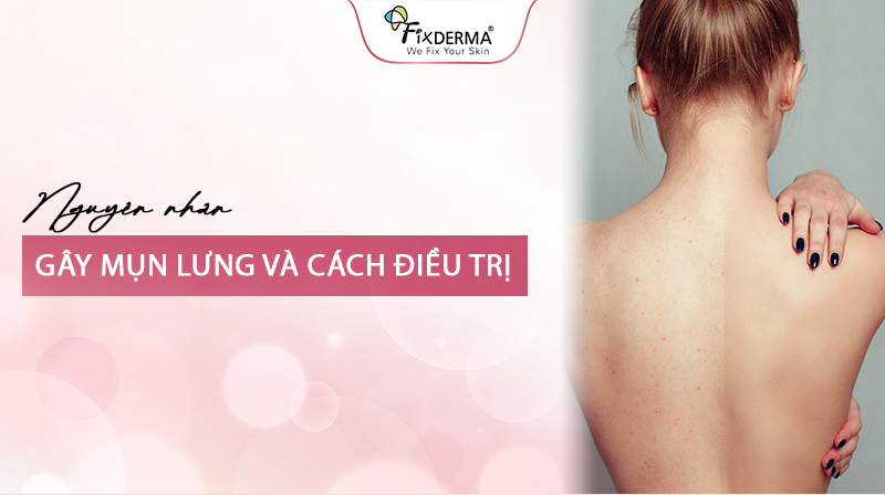 Cách điều trị mụn lưng