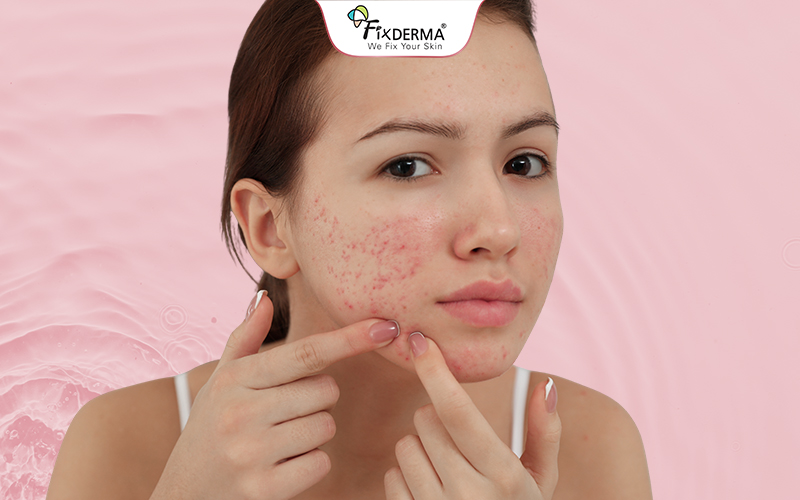 Tình trạng mụn tồi tệ hơn