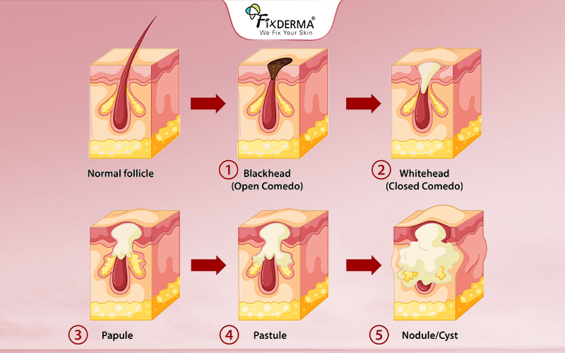 Da dầu thường gặp các vấn đề về mụn