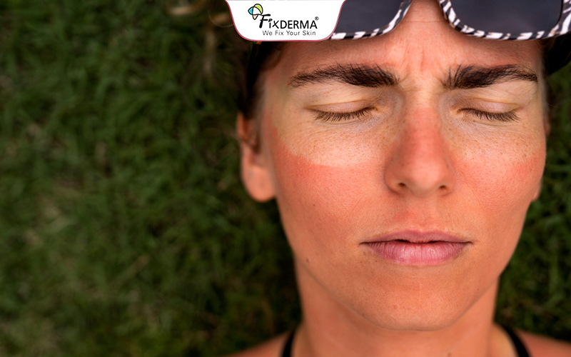 Tia UV từ ánh nắng có thể làm da bị cháy nắng