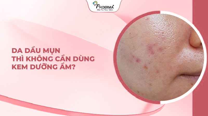 Sai lầm: Da dầu mụn thì không cần dùng kem dưỡng ẩm?