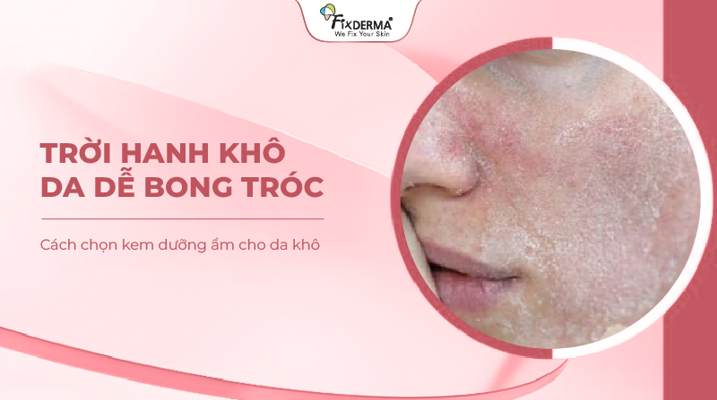 Trời hanh khô, da dễ bong tróc: Cách chọn kem dưỡng ẩm cho da khô