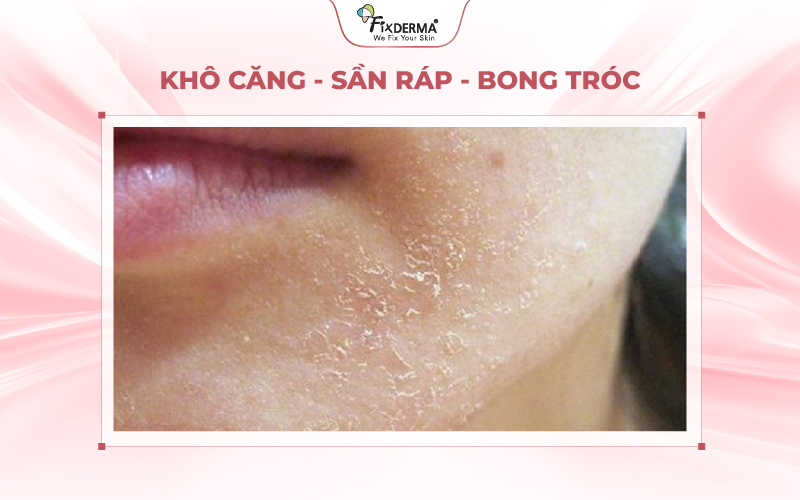 Da thường khô căng khi thời tiết chuyển lạnh